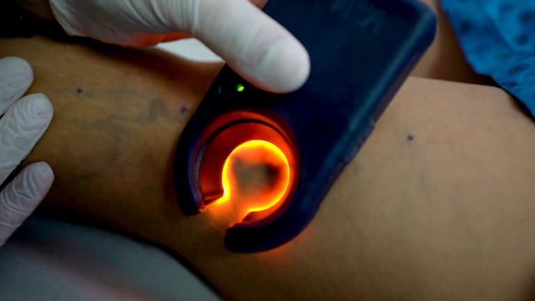 Treating small veins under a vein-viewing light